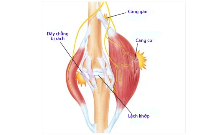 cau-truc-1559032338158570354790-crop-15590323541081131630171 Quả cầu lông đập trúng mắt gây dập nhãn cầu, nguy cơ mất thị lực - Ảnh 2.